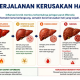 Deteksi Dini Jadi Kunci, Kerusakan Hati Bisa Dicegah Sejak Awal